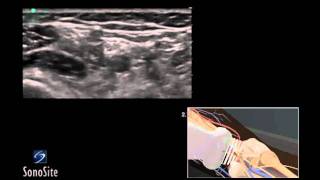 How To Ultrasound Guided Popliteal Sciatic Nerve Block 3D Video [upl. by Eisseb]