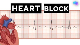 Heart Block  AV Block  ECG  EKG  OSCE Guide  UKMLA  CPSA [upl. by Areic]