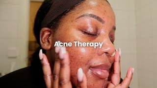 romanticising my acne scars  skin care therapy skincaretherapy acnescars [upl. by Beckett]