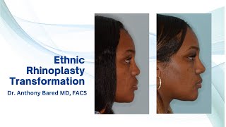 Ethnic Rhinoplasty Refinements  Anthony Bared MD FACS  Miami FL [upl. by Ennaul]