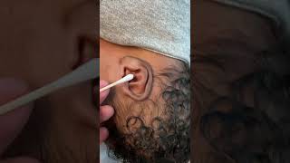 Infant Ear Molding for Conchal Crus Deformity [upl. by Hrutkay]