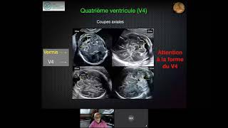 VENTRICULOMEGALIES  Webinaire Formation Echographie Obstétricale Maroc [upl. by Assenal506]