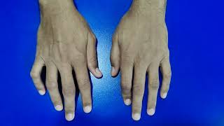 Flexion and Boutonniere Deformities in Rheumatoid Arthritis [upl. by Nilra633]