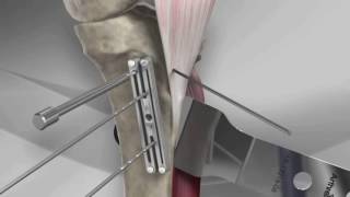 Tibial Tubercle Osteotomy [upl. by Janine70]