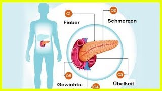 6 Symptome bei Erkrankungen der Bauchspeicheldrüse [upl. by Galan]