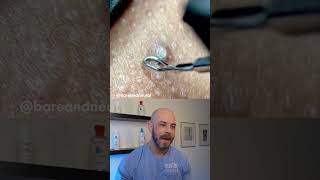 Gnarly ingrown hair removal dermreacts doctorreacts ingrownhair [upl. by Aiden]