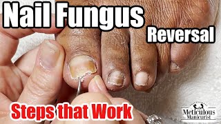 A Toenail Fungus Cure What did she do [upl. by Gnal]