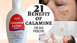 CALAMINE lotion  Lacto calamine lotion uses in detail side effects [upl. by Inaleon]