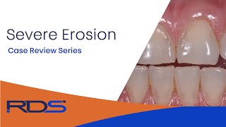 Dental clinical case review Severe Enamel Erosion [upl. by Crisey]