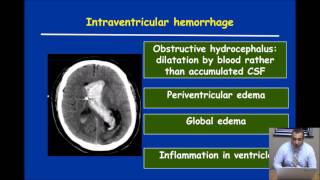 What is Next in Management of Intracerebral Hemorrhage  Teleconference [upl. by Adel]