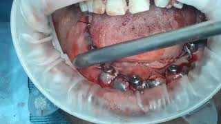 live  part 2  all on 5 with SMU Implants in atrophic mandible [upl. by Dachy319]