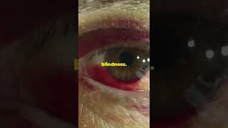 Understanding Trachoma Causes Symptoms 2024 10 22 [upl. by Akemyt]