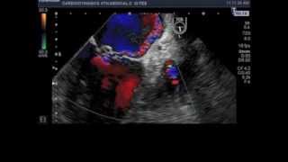 mitral valve prolapse of posterior leaflet middle scallop P2 [upl. by Doughman]