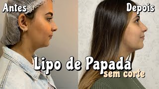 Fiz lipo de papada enzimática TERCEIRA APLICAÇÃO [upl. by Anitsud715]