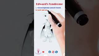 Mnemonic Edwards Syndrome neet fmge usmle biology [upl. by Haimerej761]