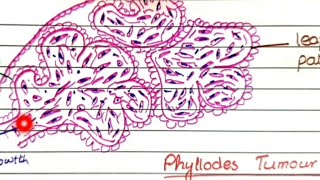 Fibroadenoma And Phyllodes Tumor  Pathology [upl. by Sivam]