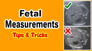 Fetal Measurements Tips and Tricks [upl. by Marna]