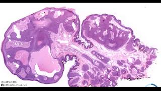 Eccrine Poroma with a twist hybrid acrospiroma explained by a dermatopathologist unknown 11 [upl. by Mcgregor]