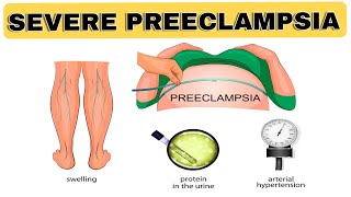 Severe Preeclampsia  NCLEX REVIEW [upl. by Bette-Ann652]