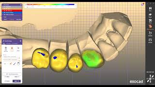 dental software design for exocad exocad [upl. by Oretos517]