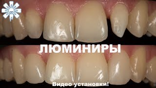 Люминиры фото до и после Видео установки [upl. by Ernestus]