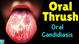 Oral Thrush  Oral Candidiasis – Symptoms Causes Diagnosis Treatment Complications [upl. by Ellenar651]