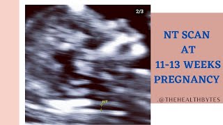 NT scan 11 to 13 weeks scan  explained Tamil version [upl. by Ecnarf]