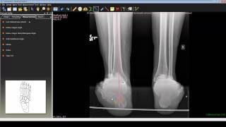 Foot and Ankle Deformity Correction with Dr Noman Siddiqui  Hindfoot Varus Deformity [upl. by Kowalski948]