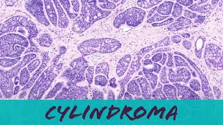 Cylindroma benign sweat gland skin adnexal tumor pathology dermpath dermatology dermatopathology [upl. by Kosey19]