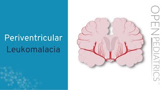 quotPeriventricular Leukomalaciaquot by Anne Hansen MD MPH for OPENPediatrics [upl. by Anilegna]