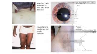 Neurofibromatosis Tipo 1 [upl. by Ches]