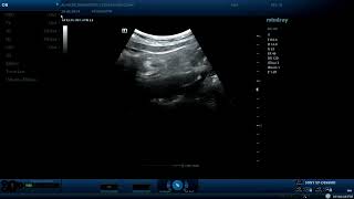 Appendicitis  ultrasound cases [upl. by Leupold]