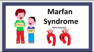 Le Syndrome de Marfan Maladie MFS Cause Symptôme Traitement Enfant Anévrisme LAorte Prolapsus 3 mn [upl. by Elyod]