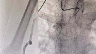 Brachial Loop With Right Subclavian Artery Tortuosity How To Get A Proper Angiogram [upl. by Michelsen]