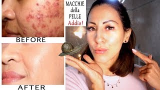 ELIMINARE MACCHIE DAL VISO ACNE  SEGNI  BRUFOLI  IMPERFEZIONI Addio per sempre  Carlitadolce [upl. by Ciri]