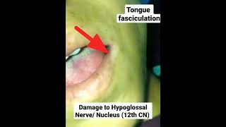 Tongue Fasciculation neet next [upl. by Oicnedif892]