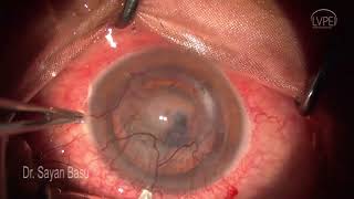 Phaco Xtreme Complex Cataract Surgery Case 3 [upl. by Hsirt463]