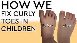 How We Fix Curly Toes in Children [upl. by Osana820]