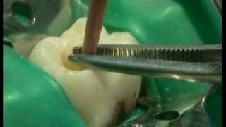 Endodontie mécanisée le système PROTAPER® principes et guide dutilisation [upl. by Eedebez423]