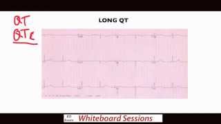 EDExam Whiteboard Session Dont Miss These ECGs  Part 2 [upl. by Ainyt]