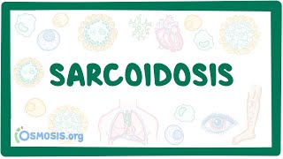 Sarcoidosis  causes symptoms diagnosis treatment pathology [upl. by Trembly]