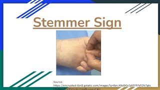 Stemmers Sign in Lymphedema A Key Diagnostic Indicator Explained [upl. by Weinhardt]