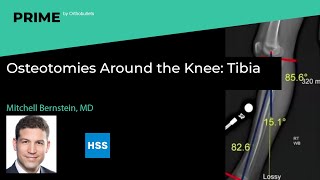 Osteotomies Around the Knee Tibia  Mitchell Bernstein MD [upl. by Asuncion]