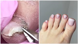 Most Satisfying Pedicure Transformation 😱 best nail polish for toes 2024 [upl. by Eittol]