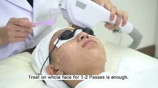 DPL Freckle removal treatment video [upl. by Ruperta903]