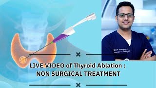 Live Video of Thyroid Ablation  Non Surgical treatment [upl. by Berardo]