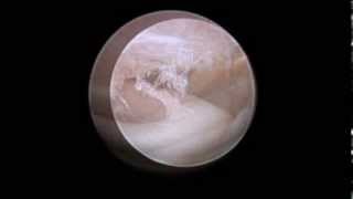 TMJ arthroscopic anatomy [upl. by Bolten]