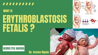 Erythroblastosis FetalisRh incompatibility and Hemolytic disease of the newborn HDN [upl. by Zehc938]