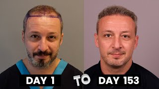 HAIR TRANSPLANT TIMELAPSE  DAY 1 TO DAY 153  GROWTH IN 5 MONTHS  BEFORE amp AFTER [upl. by Sansone]