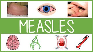 Measles  Features Management and Mnemonics [upl. by Barnaby234]